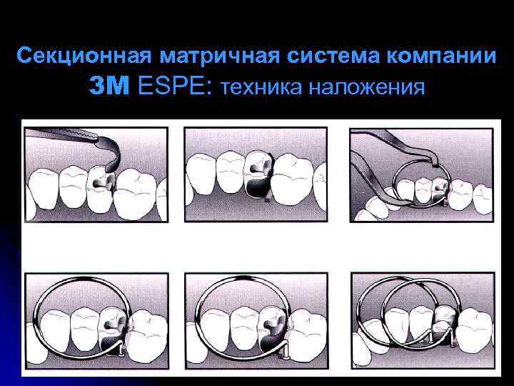 Изоляция рабочего поля матричные системы презентация