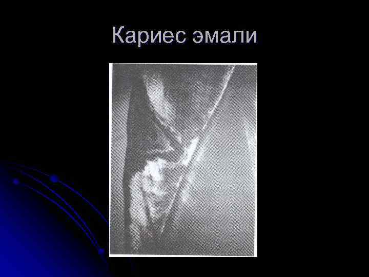 Кариес эмали 