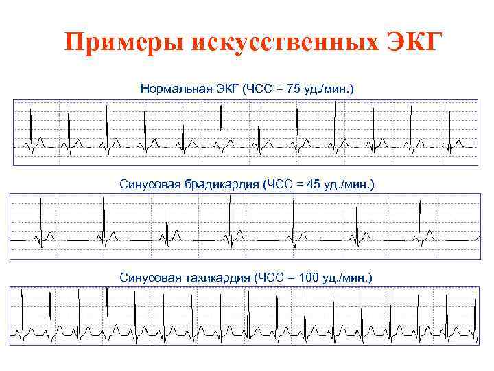Примеры искусственных ЭКГ Нормальная ЭКГ (ЧСС = 75 уд. /мин. ) Синусовая брадикардия (ЧСС