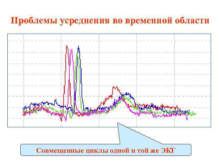 Проблемы усреднения во временной области Совмещенные циклы одной и той же ЭКГ 