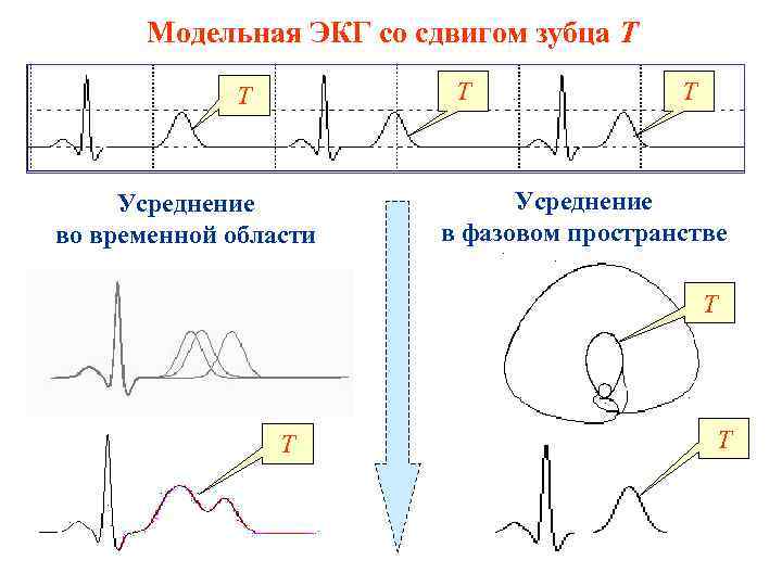 Модельная ЭКГ со сдвигом зубца Т Т Т Усреднение во временной области Т Усреднение