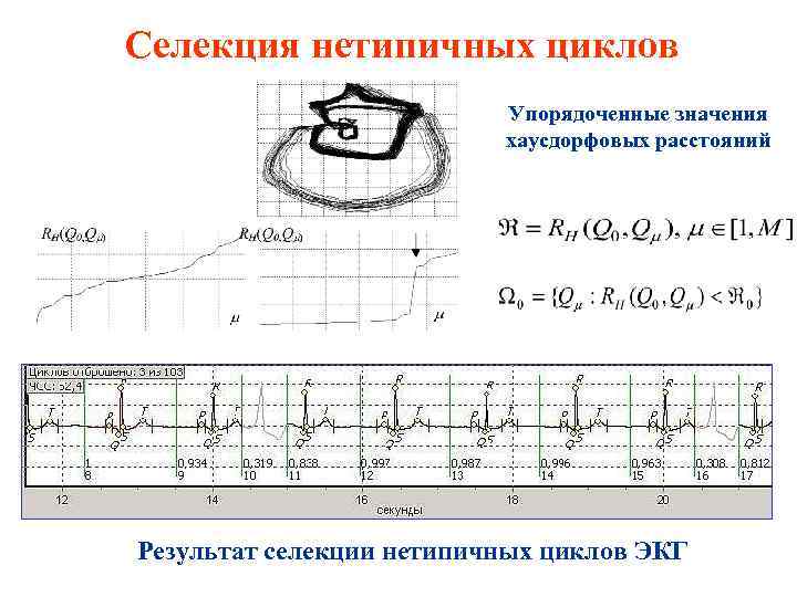 Селекция нетипичных циклов Упорядоченные значения хаусдорфовых расстояний Результат селекции нетипичных циклов ЭКГ 