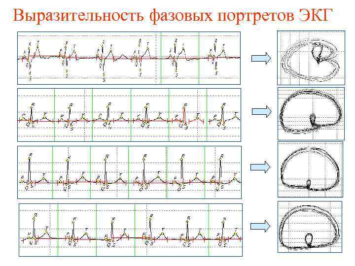 Выразительность фазовых портретов ЭКГ 