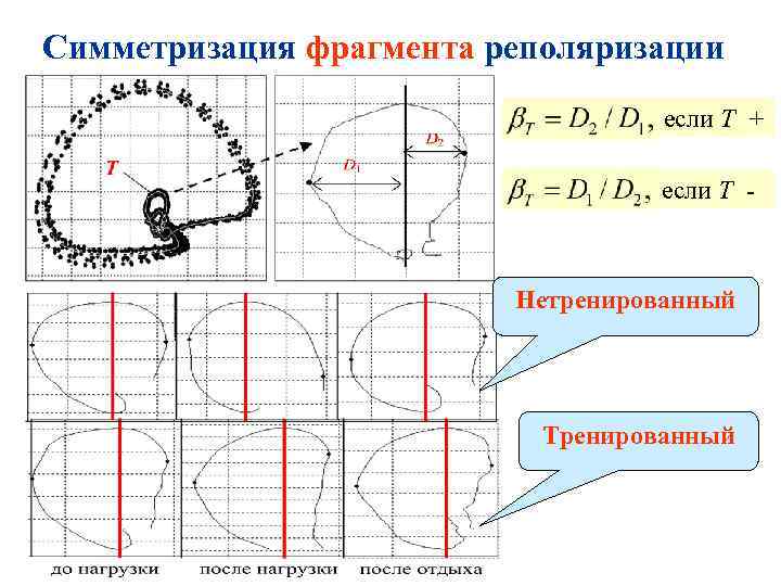 Симметризация фрагмента реполяризации если Т + если Т - Нетренированный Тренированный 