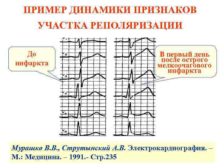 Умеренные изменения реполяризации нижней стенки