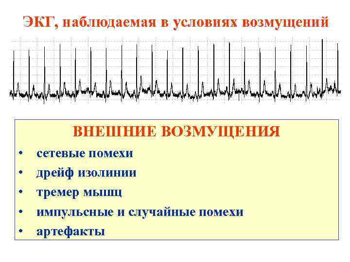 ЭКГ, наблюдаемая в условиях возмущений ВНЕШНИЕ ВОЗМУЩЕНИЯ • сетевые помехи • дрейф изолинии •