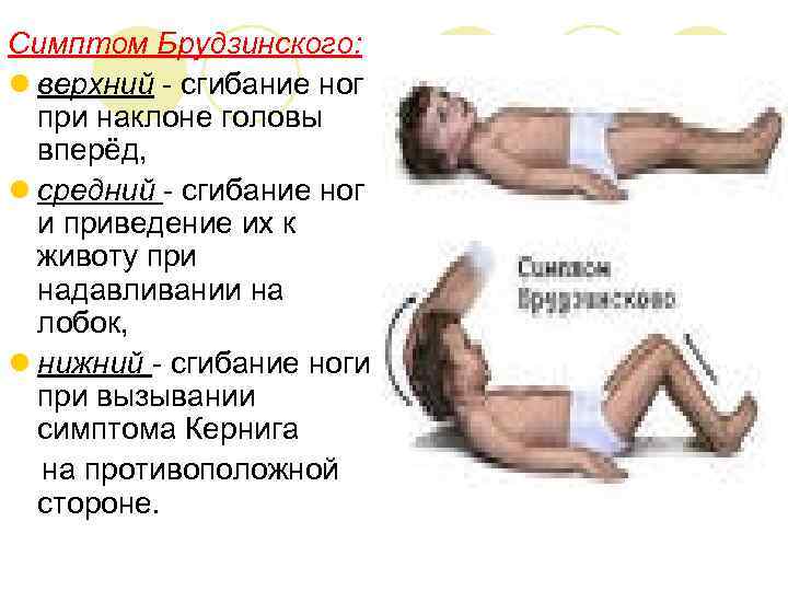 Симптом Брудзинского: l верхний - сгибание ног при наклоне головы вперёд, l средний -