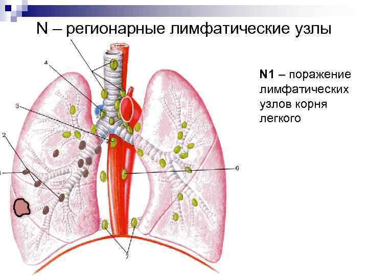 N – регионарные лимфатические узлы N 1 – поражение лимфатических узлов корня легкого 