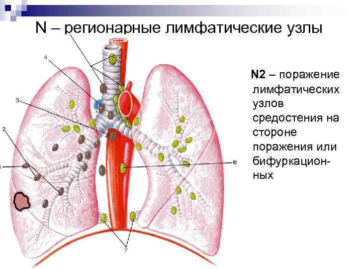 N – регионарные лимфатические узлы N 2 – поражение лимфатических узлов средостения на стороне