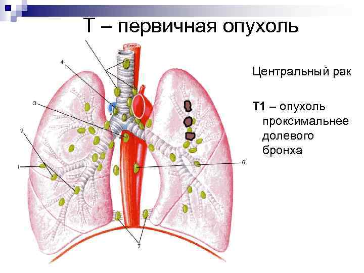 Т – первичная опухоль Центральный рак Т 1 – опухоль проксимальнее долевого бронха 