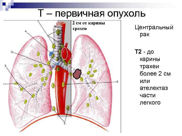 Т – первичная опухоль Центральный рак Т 2 - до карины трахеи более 2