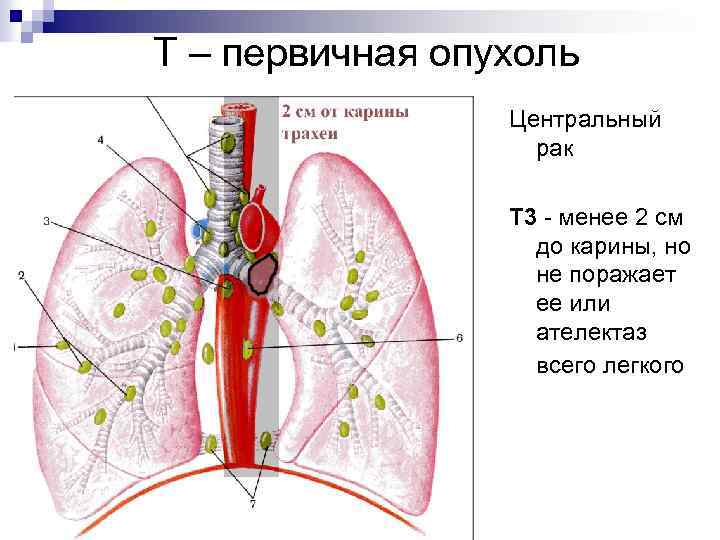 Т – первичная опухоль Центральный рак Т 3 - менее 2 см до карины,