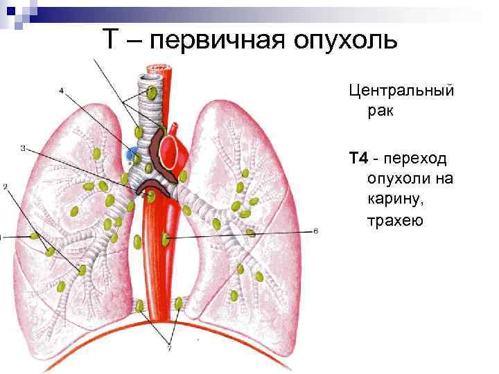 Т – первичная опухоль Центральный рак Т 4 - переход опухоли на карину, трахею