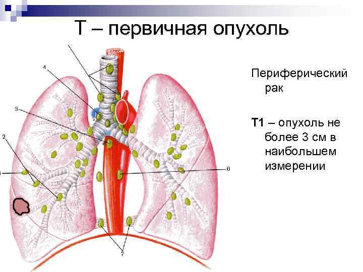 Т – первичная опухоль Периферический рак Т 1 – опухоль не более 3 см