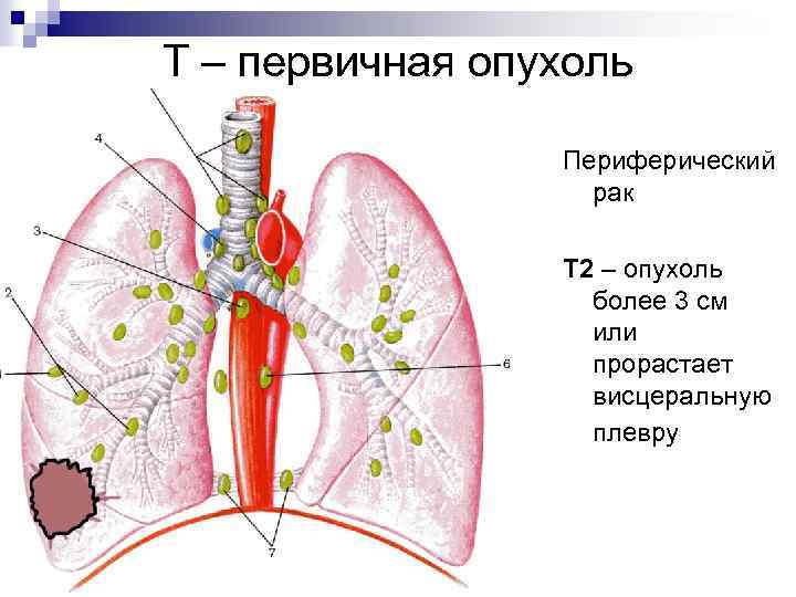 Т – первичная опухоль Периферический рак Т 2 – опухоль более 3 см или