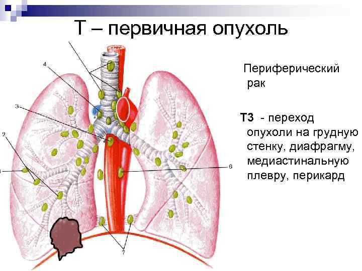 Т – первичная опухоль Периферический рак Т 3 - переход опухоли на грудную стенку,