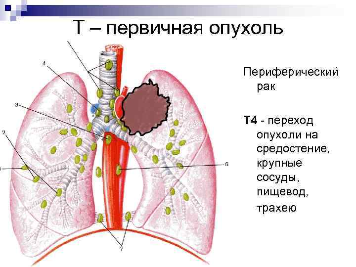 Т – первичная опухоль Периферический рак Т 4 - переход опухоли на средостение, крупные