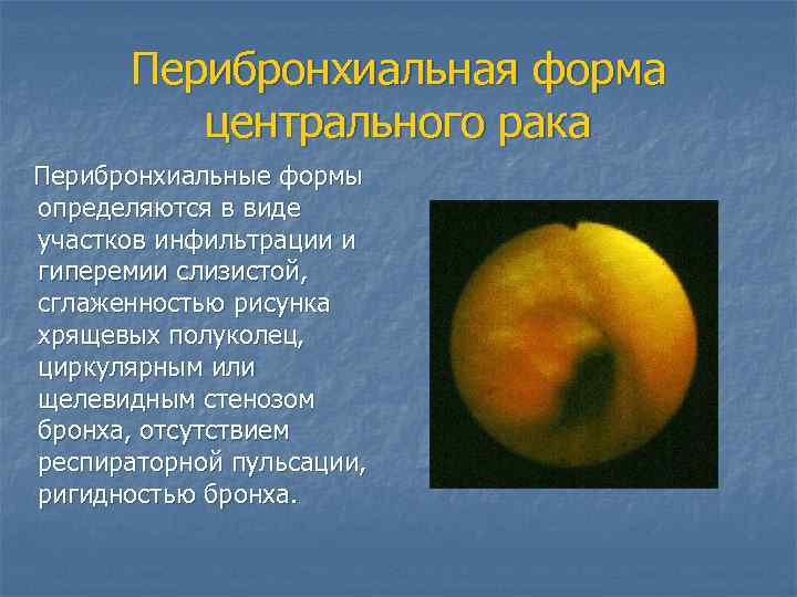 Перибронхиальная форма центрального рака Перибронхиальные формы определяются в виде участков инфильтрации и гиперемии слизистой,