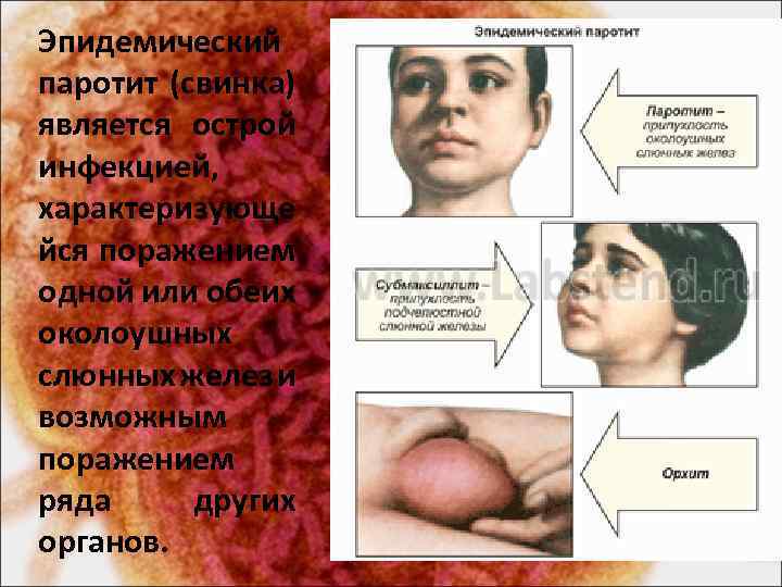Эпидемический паротит (свинка) является острой инфекцией, характеризующе йся поражением одной или обеих околоушных слюнных