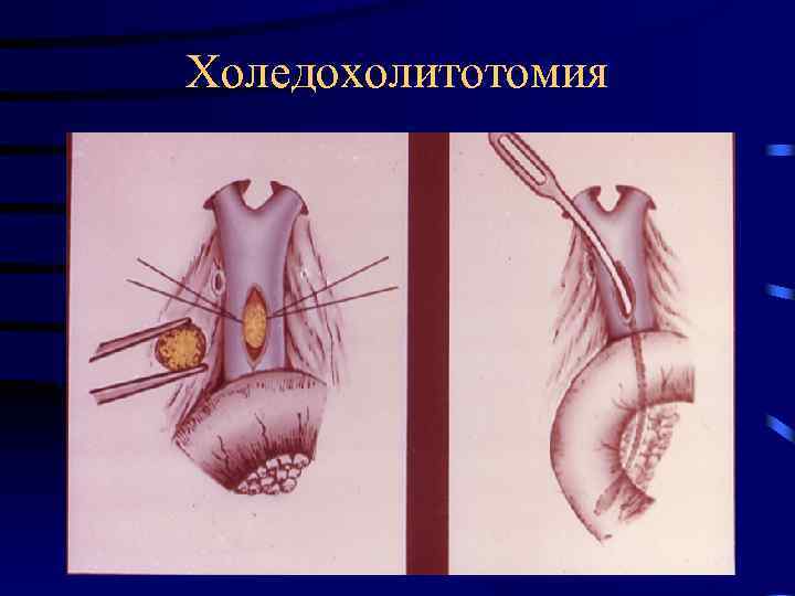 Холедохолитотомия 