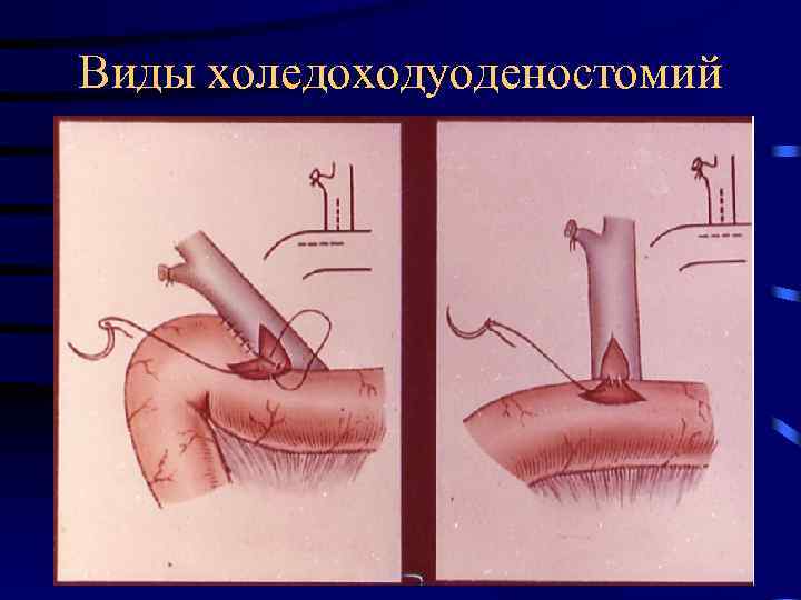 Виды холедоходуоденостомий 
