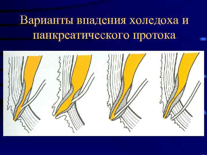 Варианты впадения холедоха и панкреатического протока 