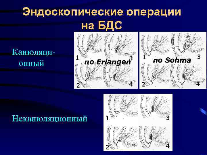 Эндоскопические операции на БДС Канюляционный 1 3 1 4 2 по Erlangen 2 Неканюляционный