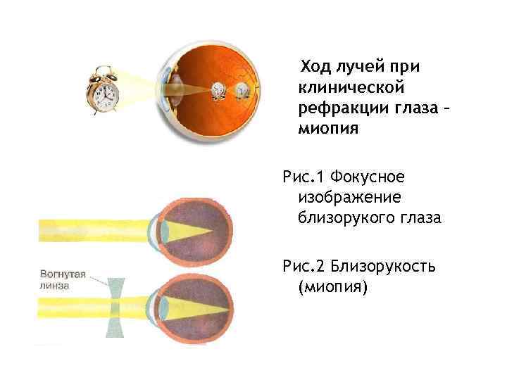 Ход лучей при клинической рефракции глаза – миопия Рис. 1 Фокусное изображение близорукого глаза