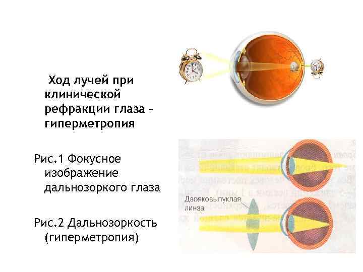 Ход лучей при клинической рефракции глаза – гиперметропия Рис. 1 Фокусное изображение дальнозоркого глаза