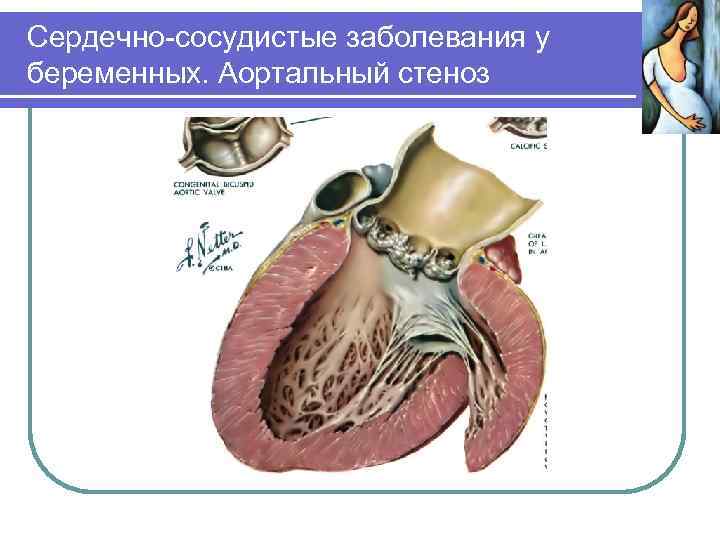Сердечно-сосудистые заболевания у беременных. Аортальный стеноз 