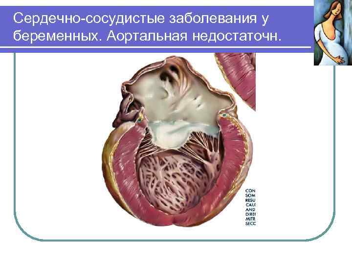 Сердечно-сосудистые заболевания у беременных. Аортальная недостаточн. 