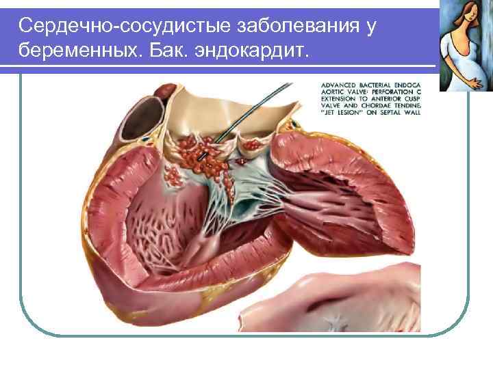 Сердечно-сосудистые заболевания у беременных. Бак. эндокардит. 
