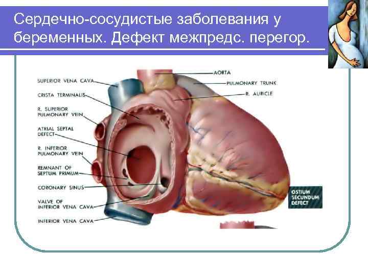 Сердечно-сосудистые заболевания у беременных. Дефект межпредс. перегор. 