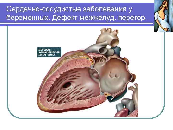 Сердечно-сосудистые заболевания у беременных. Дефект межжелуд. перегор. 