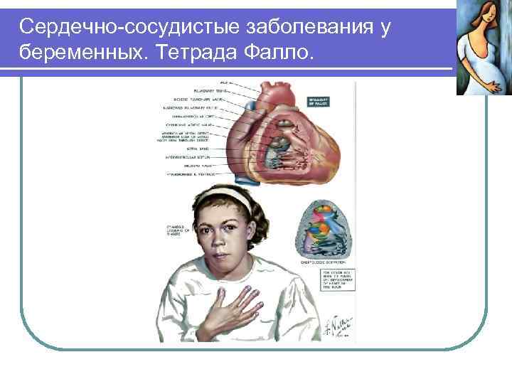 Сердечно-сосудистые заболевания у беременных. Тетрада Фалло. 
