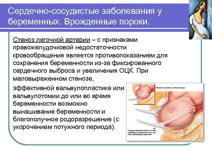 Сердечно-сосудистые заболевания у беременных. Врожденные пороки. Стеноз легочной артерии – с признаками правожелудочковой недостаточности