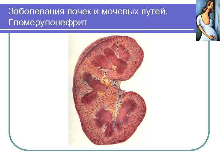 Заболевания почек и мочевых путей. Гломерулонефрит 