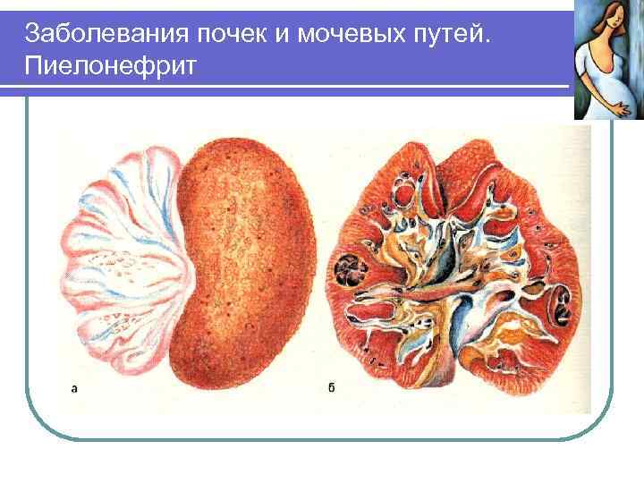 Заболевания почек и мочевых путей. Пиелонефрит 