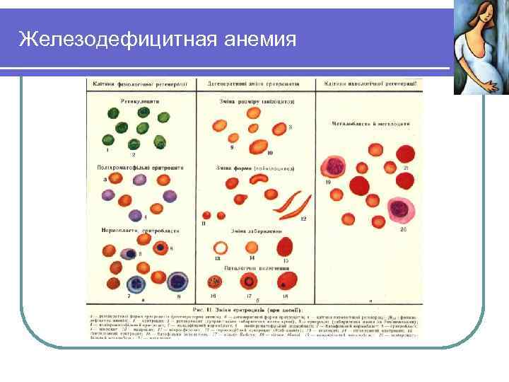 Железодефицитная анемия 