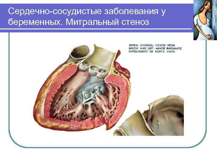 Сердечно-сосудистые заболевания у беременных. Митральный стеноз 