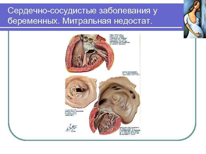 Сердечно-сосудистые заболевания у беременных. Митральная недостат. 