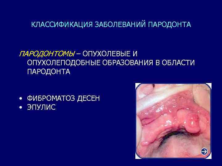 КЛАССИФИКАЦИЯ ЗАБОЛЕВАНИЙ ПАРОДОНТА ПАРОДОНТОМЫ – ОПУХОЛЕВЫЕ И ОПУХОЛЕПОДОБНЫЕ ОБРАЗОВАНИЯ В ОБЛАСТИ ПАРОДОНТА • ФИБРОМАТОЗ