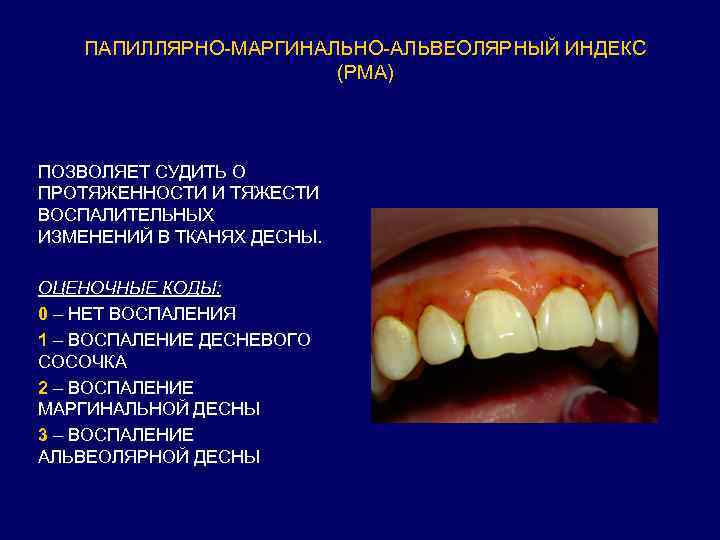 ПАПИЛЛЯРНО-МАРГИНАЛЬНО-АЛЬВЕОЛЯРНЫЙ ИНДЕКС (РМА) ПОЗВОЛЯЕТ СУДИТЬ О ПРОТЯЖЕННОСТИ И ТЯЖЕСТИ ВОСПАЛИТЕЛЬНЫХ ИЗМЕНЕНИЙ В ТКАНЯХ ДЕСНЫ.