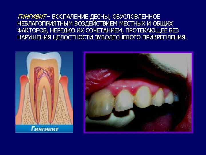 ГИНГИВИТ – ВОСПАЛЕНИЕ ДЕСНЫ, ОБУСЛОВЛЕННОЕ НЕБЛАГОПРИЯТНЫМ ВОЗДЕЙСТВИЕМ МЕСТНЫХ И ОБЩИХ ФАКТОРОВ, НЕРЕДКО ИХ СОЧЕТАНИЕМ,