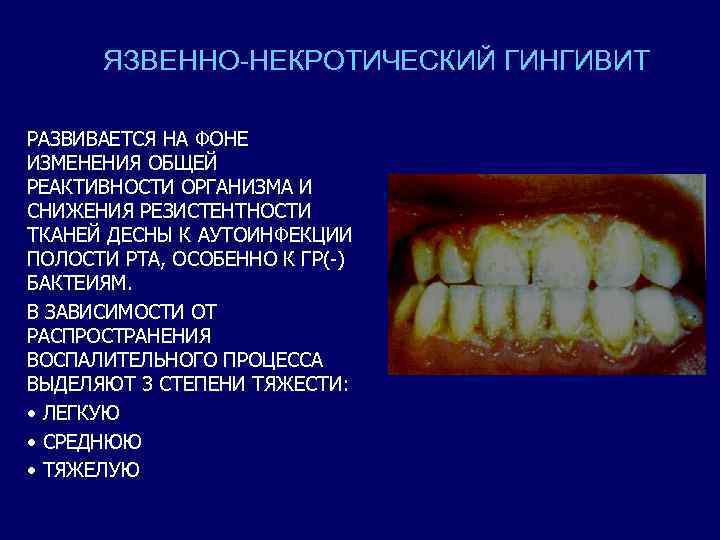 Язвенно некротический гингивостоматит фото