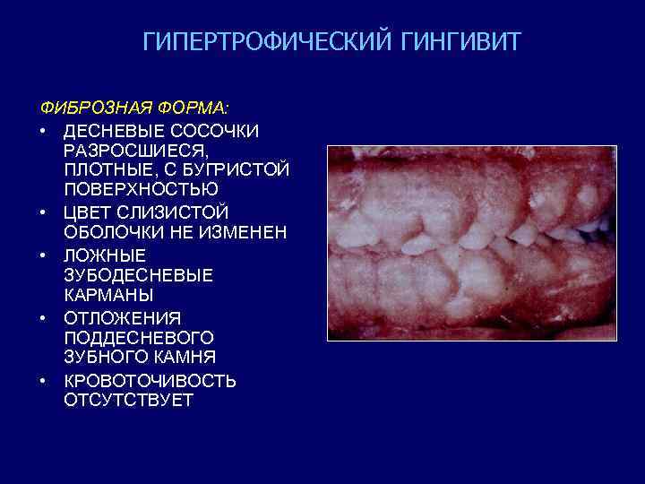 Гингивит гипертрофический презентация