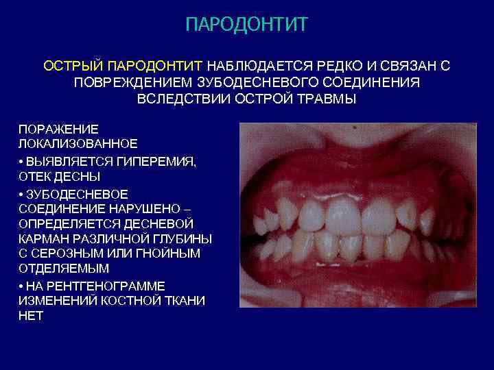 ПАРОДОНТИТ ОСТРЫЙ ПАРОДОНТИТ НАБЛЮДАЕТСЯ РЕДКО И СВЯЗАН С ПОВРЕЖДЕНИЕМ ЗУБОДЕСНЕВОГО СОЕДИНЕНИЯ ВСЛЕДСТВИИ ОСТРОЙ ТРАВМЫ