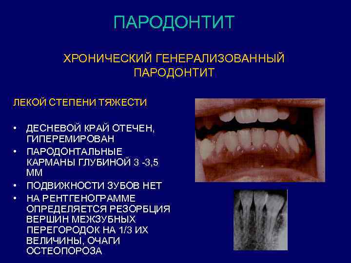 Презентация болезни пародонта