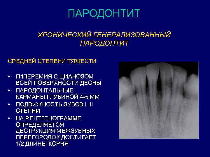 ПАРОДОНТИТ ХРОНИЧЕСКИЙ ГЕНЕРАЛИЗОВАННЫЙ ПАРОДОНТИТ СРЕДНЕЙ СТЕПЕНИ ТЯЖЕСТИ • ГИПЕРЕМИЯ С ЦИАНОЗОМ ВСЕЙ ПОВЕРХНОСТИ ДЕСНЫ