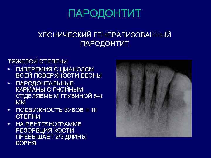 Генерализованный пародонтит презентация